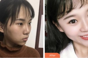 淮安光明眼科醫(yī)院劉鳳整形價(jià)格表附切開雙眼皮案例展示