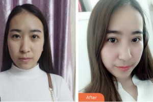 淮安光明眼科醫(yī)院劉巨平整形價(jià)格表附切開雙眼皮案例展示