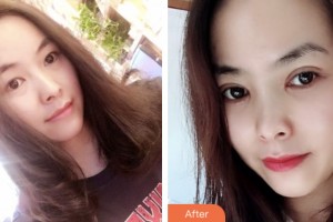 淮安光明眼科醫(yī)院姜蘇整形價(jià)格表附切開雙眼皮案例展示