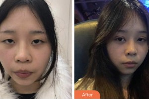 淮安光明眼科醫(yī)院宋建軍整形價(jià)格表附切開雙眼皮案例展示