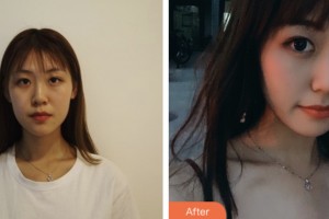 淮安光明眼科醫(yī)院張勝玉整形價(jià)格表附埋線雙眼皮案例展示