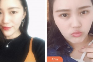 婁底市中醫(yī)院燒傷整形科彭細(xì)峰 整形價(jià)格表附眼部綜合案例展示