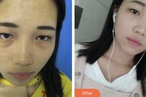 婁底市中醫(yī)院燒傷整形科賀建雄整形價(jià)格表附激光去眼袋案例展示