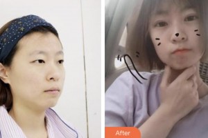 婁底市中醫(yī)院燒傷整形科鄧建光整形價(jià)格表附切開雙眼皮案例展示