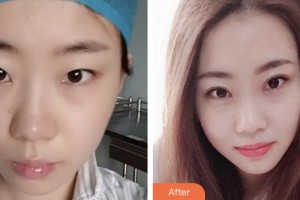 婁底德美醫(yī)療整形美容診所譚敏整形價(jià)格表附眼部綜合案例展示