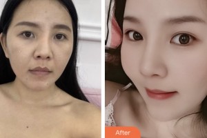 拉薩維多利亞整形美容醫(yī)院唐德邦整形價(jià)格表附美白貼片案例展示