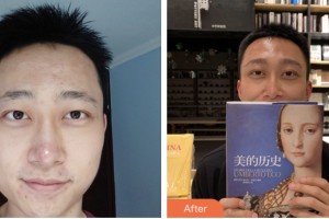 荊門市第一人民醫(yī)院醫(yī)學美容中心劉艷明整形價格表附種眉毛案例展示