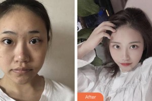 荊門市第一人民醫(yī)院醫(yī)學美容中心閔峰整形價格表附埋線提升案例展示