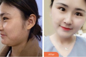 荊門市第一人民醫(yī)院醫(yī)學美容中心謝和新整形價格表附超聲提拉案例展示