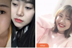 荊門市第一人民醫(yī)院醫(yī)學美容中心嚴加林整形價格表附牙齒矯正案例展示