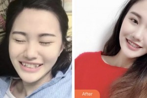 荊門鐘祥佳美醫(yī)療美容門診部李玖玲整形價格表附金屬托槽矯正案例展示