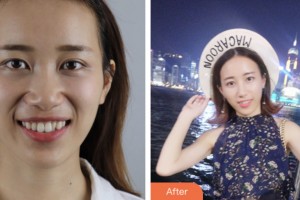 荊門小白兔口腔醫(yī)院趙宗富整形價格表附牙齒隱形矯正案例展示