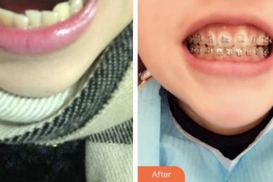 荊門小白兔口腔醫(yī)院許強整形價格表附冷光美白案例展示