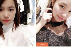 荊門小白兔口腔醫(yī)院廖開禹整形價格表附牙齒隱形矯正案例展示