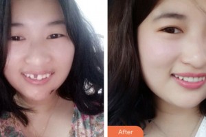 荊門小白兔口腔醫(yī)院李華強整形價格表附種植牙案例展示