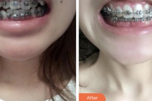 荊門小白兔口腔醫(yī)院全旭整形價格表附金屬托槽矯正案例展示