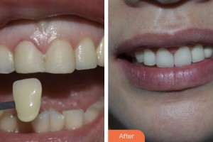 荊門小白兔口腔醫(yī)院朱鑫整形價格表附牙貼面案例展示