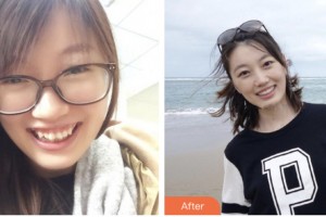 荊門小白兔口腔醫(yī)院謝輝整形價格表附金屬托槽矯正案例展示