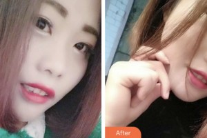 荊門小白兔口腔醫(yī)院伍愛民整形價格表附超聲波潔牙案例展示