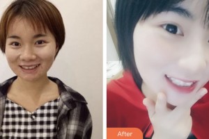 荊門小白兔口腔醫(yī)院陳中浩整形價格表附牙齒隱形矯正案例展示