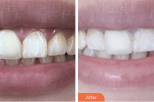 荊門小白兔口腔醫(yī)院李媛整形價格表附超聲波潔牙案例展示