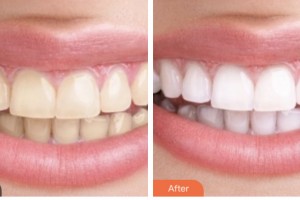 荊門市口腔醫(yī)院董平整形價格表附金屬托槽矯正案例展示