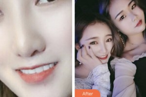 荊門市口腔醫(yī)院劉明海整形價格表附牙貼面案例展示