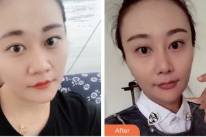 株洲三三一周醫(yī)生整形美容診所周建屏整形價格表附鼻部綜合案例展示