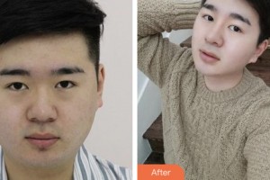 株洲藝佳醫(yī)療美容?？漆t(yī)院李文軍整形價格表附假體隆鼻案例展示