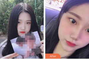 株洲藝佳醫(yī)療美容專科醫(yī)院高謝輝整形價格表附耳軟骨復合隆鼻案例展示