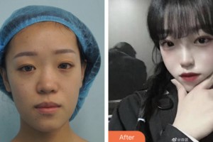 株洲中雅醫(yī)療美容門診部滕召勇整形價格表附墊鼻基底案例展示