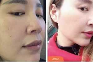 株洲中雅醫(yī)療美容門診部周唯鈞整形價格表附鼻部綜合案例展示