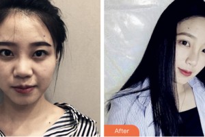 株洲嘉美醫(yī)療整形美容診所李智生整形價格表附鼻部綜合案例展示