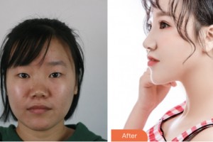 株洲市中心醫(yī)院整形美容科黃挺整形價格表附耳軟骨復合隆鼻案例展示