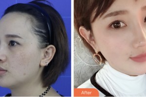 株洲市中心醫(yī)院整形美容科歐陽霞整形價格表附鼻部綜合案例展示