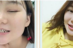 泰州第四人民醫(yī)院整形美容分院董磊整形價(jià)格表附牙齒隱形矯正案例展示