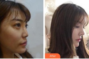 泰州麗都醫(yī)療美容醫(yī)院洪基石整形價(jià)格表附鼻部綜合案例展示