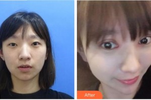 泰州市人民醫(yī)院燒傷整形科陳傳俊整形價格表附眼部綜合案例展示