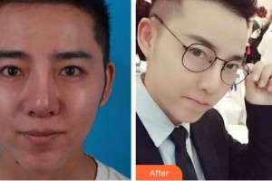 泰州愛爾眼科醫(yī)院郁素蘭整形價(jià)格表附內(nèi)切祛眼袋案例展示