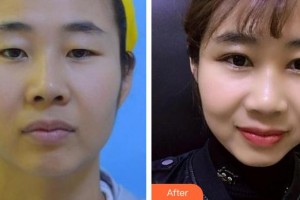 泰州北極星口腔門診部張海瀚整形價(jià)格表附隱形托槽矯正案例展示