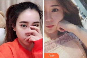 泰州玲瓏口腔門診部黃雨琴整形價(jià)格表附牙齒隱形矯正例展示