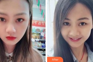 泰州拜博口腔醫(yī)院姜潤整形價格表附牙齒隱形矯正案例展示