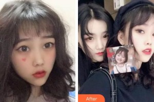 泰州拜博口腔醫(yī)院劉延峰整形價格表附牙齒隱形矯正案例展示