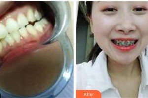 鎮(zhèn)江汪有國整形美容醫(yī)院汪有國整形價(jià)格表附牙齒陶瓷矯正案例展示