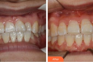 鎮(zhèn)江市第一人民醫(yī)院美容整形科何雪蓮住院醫(yī)師整形價格表附金屬托槽矯正案例展示