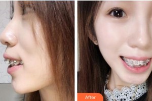 鎮(zhèn)江市第一人民醫(yī)院美容整形科王金龍住院醫(yī)師整形價格表附金屬托槽矯正案例展示