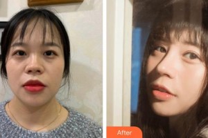 鎮(zhèn)江康復眼科醫(yī)院（鎮(zhèn)江市第—人民醫(yī)院眼科）張芹整形價格表附肋軟骨隆鼻案例展示