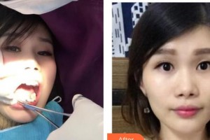 鎮(zhèn)江市口腔醫(yī)院劉振中整形價(jià)格表附金屬托槽矯正案例展示