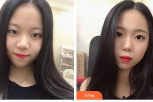 湘潭市中心醫(yī)院醫(yī)學(xué)整形美容科陳婷婷整形價格表附鼻部綜合案例展示