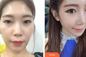 湘潭市中心醫(yī)院醫(yī)學(xué)整形美容科李志剛整形價格表附鼻部綜合案例展示